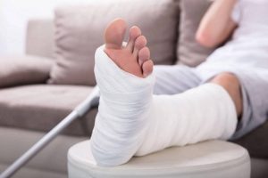 راه رفتن بعد از بازکردن گچ پا