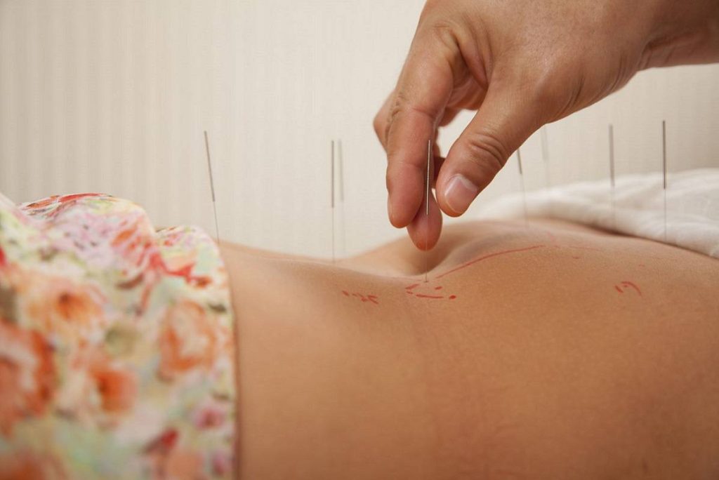 طب سوزنی برای اعصاب