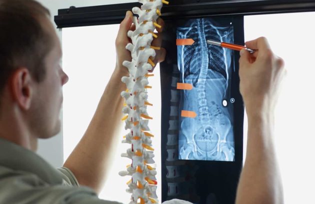 Photo of mild scoliosis