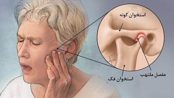 اختلال مفصل گیجگاهی فکی (TMJ) اختلال مفصل گیجگاهی فکی (TMJ)