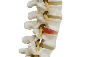 علائم التهاب دیسک کمر