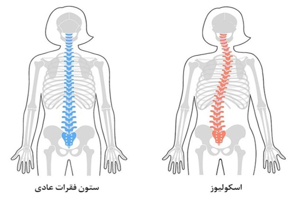 اسکولیوز و ازدواج