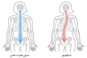 اسکولیوز و ازدواج